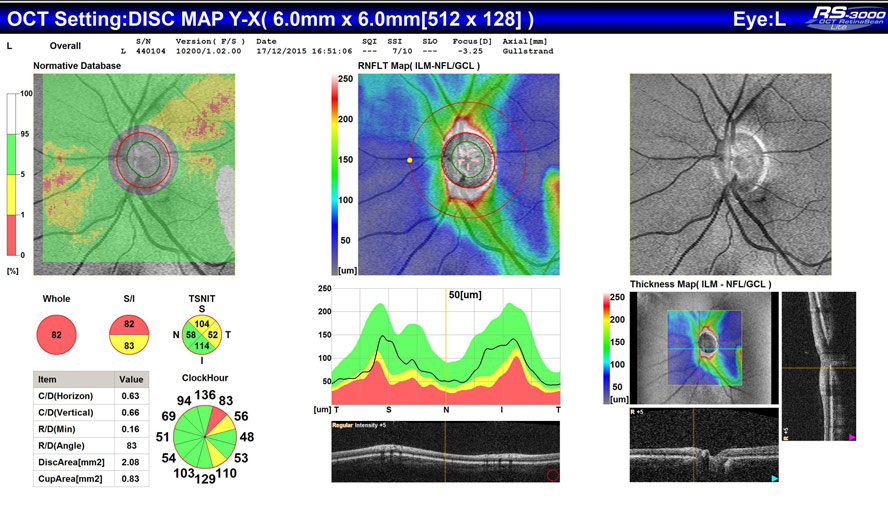 Glaucoma Optic Nerve and Functional Testing